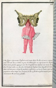 Cross-Sectional Diagram of a Baby Pulled from the Womb, from a Book by Madame Angelique Le Boursier du Coudray, engraved by J. Robert, 1783 by P. Chapparre